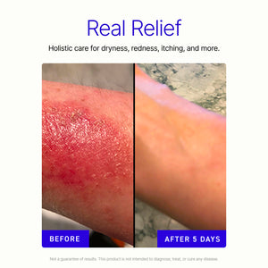 The Eczema Relief Kit